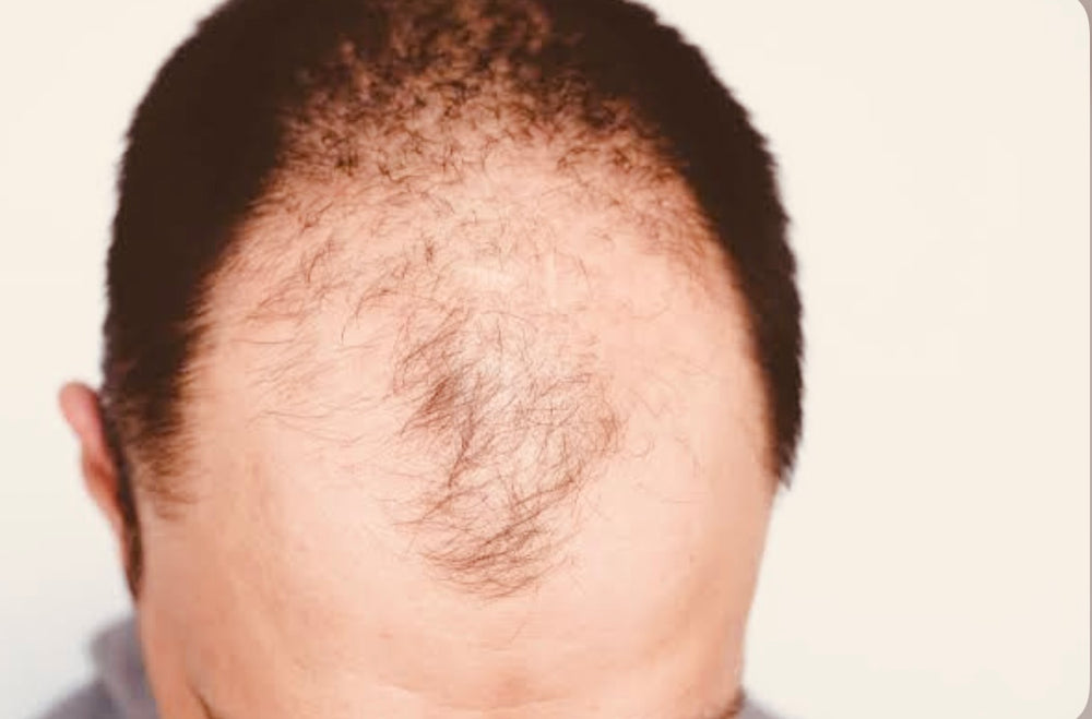 That B.ald spot … what is male pattern baldness ?